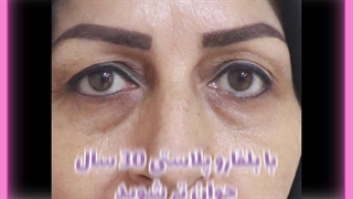 رفع پف چشم
