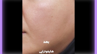 لیفت صورت