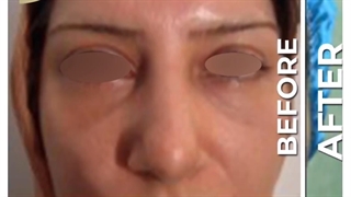 این همه تغییر فقط با از بین رفتن پف زیر چشم ؟