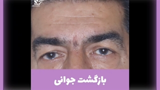 برداشتن پف چشم