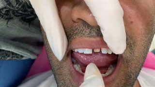 روکش تمام سرامیکی دندان