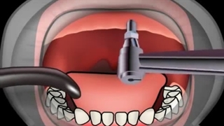 فیلم ایمپلنت دندان به روش پانچ