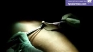 فیلم درمان قطعی زگیل تناسلی در کلینیک اچ پی وی