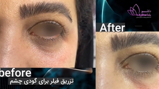 تزریق فیلر برای رفع گودی زیر چشم زیبا