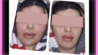 تزریق چربی فقط گونه لیفت ابرو
