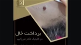 برداشتن خال