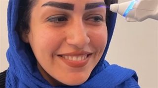 کاشت ابرو طبیعی