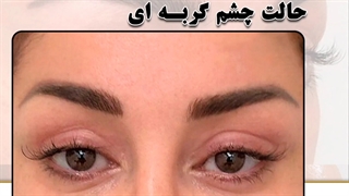 بلفاروپلاستی چشم گربه ای