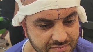 کاشت مو با بانک مو ضعیف