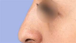 جراحی بینی استخوانی