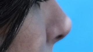 6 ماه بعد عمل بینی به مدل طبیعی