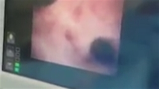 جهت سنگ های قسمت های مختلف کلیه