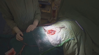 درمان تنگی کانال نخاع