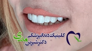 لمینت سرامیکی ایمکس