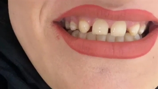 8 واحد لمینت سرامیکی ایمکس