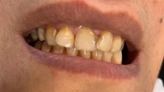 شش واحد لمینت سرامیکی ایمکس