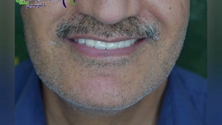 ایمپلنت دندان