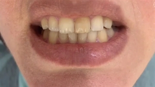 لمینت سرامیکی ایمکس