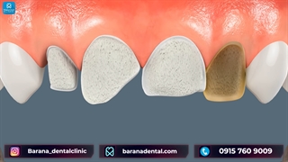 نحوه اجرای لمینت دندان جلو شکسته و پوسیده