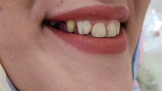 درمان ترکیبی روکش تمام سرامیک و لمینیت تمام سرامیکی