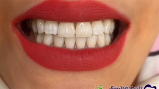 نمونه کار ( بلیچینگ )