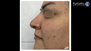 جراحی زیبایی بینی