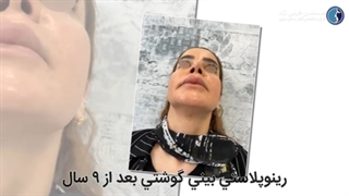 رینوپلاستی بینی گوشتی برای زیباجوی عزیزمون بعد از ۹ سال