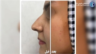جراحی رینوپلاستی بینی با انحراف شدید