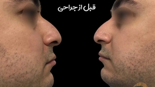 نمونه جراحی زیبایی بینی