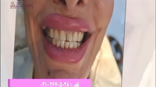 ۲۰ واحد کامپوزیت رنگ بلیچ دو فک