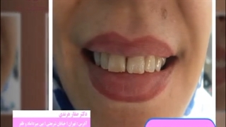 ۶ واحد کامپوزیت زیبایی فک بالا