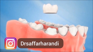 کلیپ روکش دندان