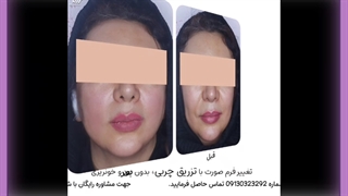 تزریق چربی به صورت