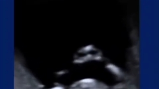 جنین که با دستهایش یک قلب را نشان میدهد