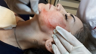 میکرونیدلینگ صورت عصب‌کشی