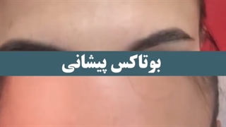 بوتاکس پیشانی