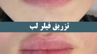 تزریق ژل لب روسی