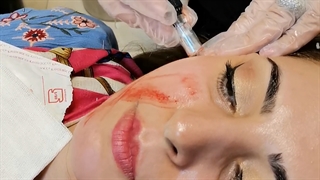 جوانسازی پوست صورت با میکرونیدنیگ لیزر مو