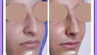 لیفت بینی