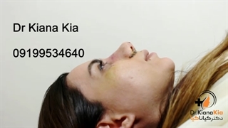 برداشتن‌اتل‌بینی