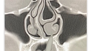 ساختار درونی بینی و آنالیز ان توسط دکتر کیا