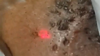 فیلم لیزر زگیل تناسلی در partoclinic.com