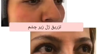 بلافاصله بعد از تزریق ژل چشم برای مراجعه کننده عزیزمون