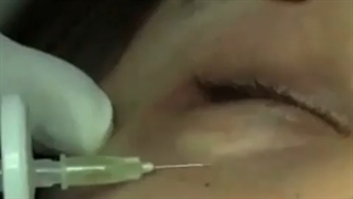 رفع تیرگی دور چشم با کربوکسی تراپی