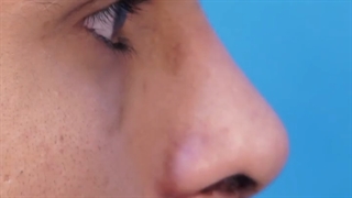 جراحی بینی غضروفی