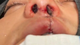 مورد شکاف لب و شکاف بینی  .