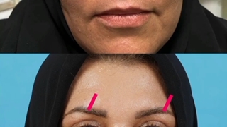 بلفاروپلاستی پلک بالا