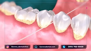 ضرورت جرم گیری برای جلوگیری از تحلیل لثه