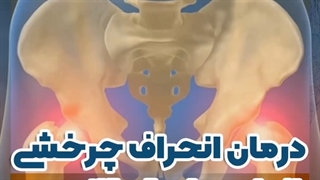 درمان انحراف چرخشی اندام های تحتانی