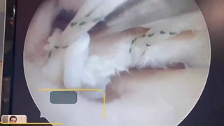جراحی پارگی ریشه منیسک
